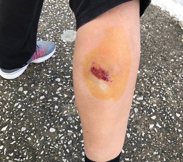 Αδέσποτος σκύλος δάγκωσε γυναίκα στους Γαργαλιάνους