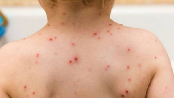 12 κρούσματα ιλαράς στο Νοσοκομείο Καλαμάτας