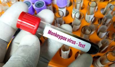 Ευλογιά των Πιθήκων: 13 περιστατικά στην Ελλάδα