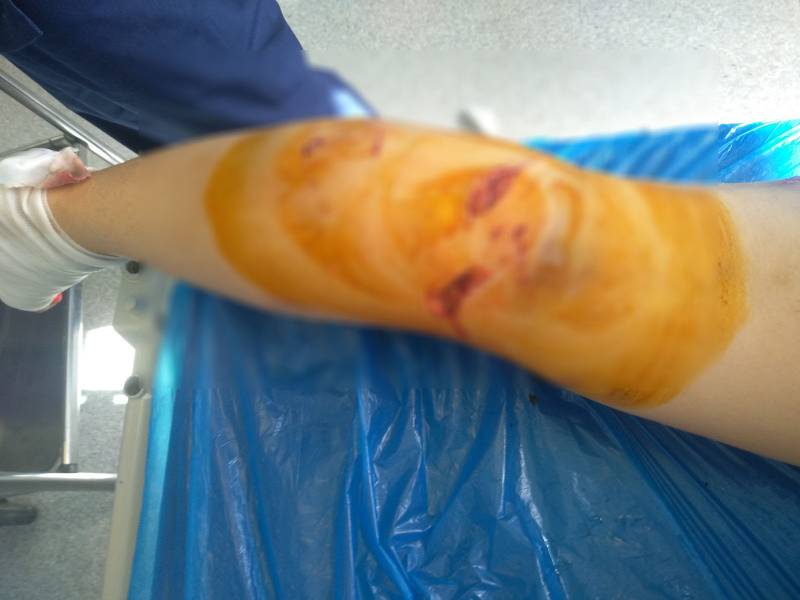 Καλαμάτα: Αγρια επίθεση αδέσποτων σκυλιών σε 34χρονη στο Ασπρόχωμα (σοκαριστικές εικόνες)