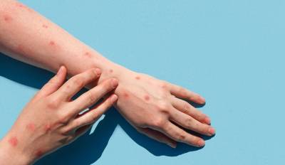 CDC: Πάνω από 1.000 τα κρούσματα ευλογιάς των πιθήκων στις ΗΠΑ