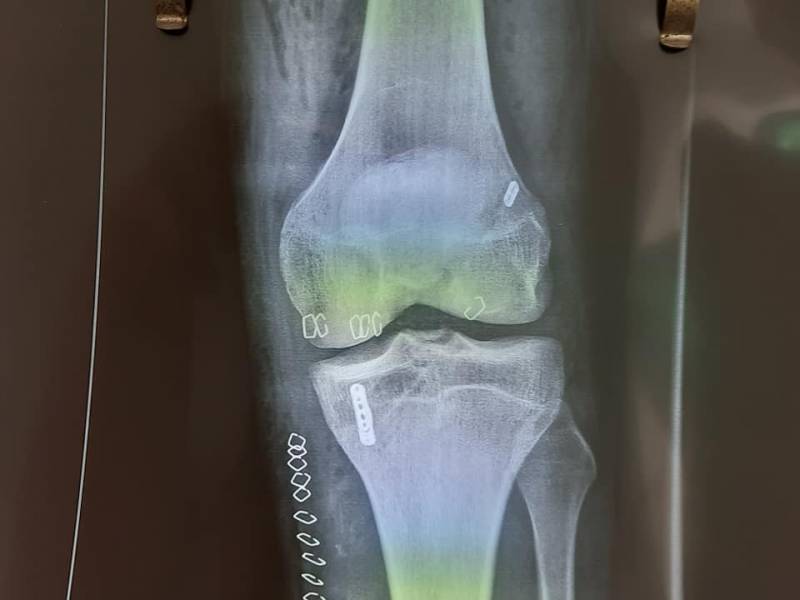 Αρθροσκοπική συνδεσμοπλαστική για πρώτη φορά στο Νοσοκομείο Κυπαρισσίας