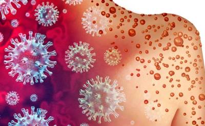 Ευλογιά των πιθήκων - ΠΟΥ: Η Ευρώπη «οδεύει προς τη σωστή κατεύθυνση»