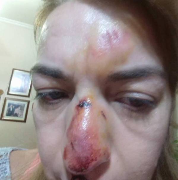 Σε εργολάβο φορτώνει τις ευθύνες ο Βεργόπουλος για τον τραυματισμό γυναίκας στην Καλαμάτα