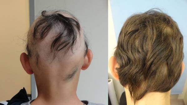 Tα αιμοπετάλια η «θεραπεία» για τη γυροειδή αλωπεκία