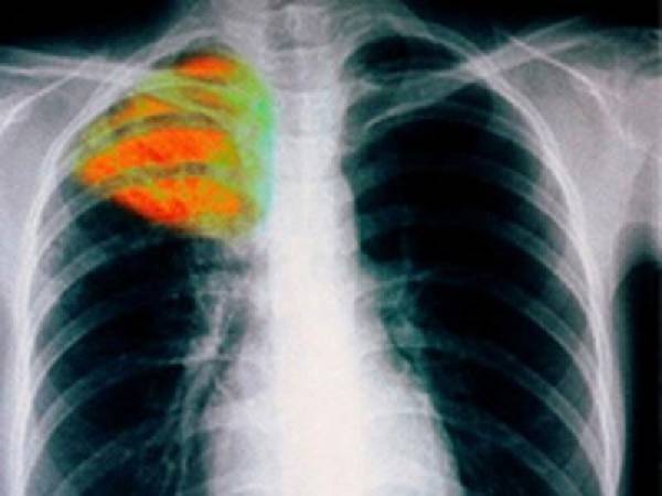 24η Μαρτίου: Παγκόσμια Ημέρα κατά της Φυματίωσης