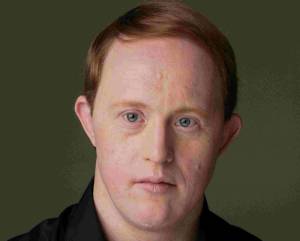 Chris Burke: Ο ηθοποιός που άλλαξε τον τρόπο αντιμετώπισης του συνδρόμου down στις ΗΠΑ