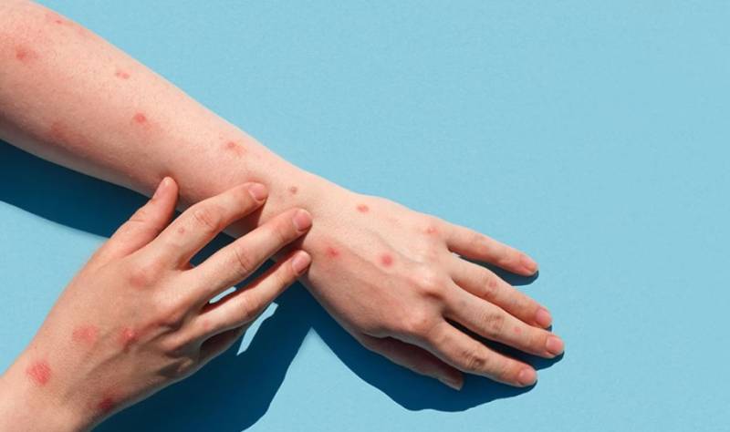 Τουρκία: Πρώτο κρούσμα ευλογιάς πιθήκων σε 37χρονο άνδρα